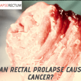 Can Rectal Prolapse Cause Cancer?