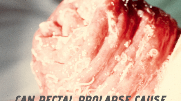Can Rectal Prolapse Cause Cancer? Can Rectal Prolapse Cause Cancer?