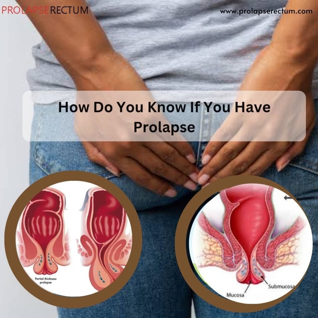 How Do You Know If You Have Prolapse