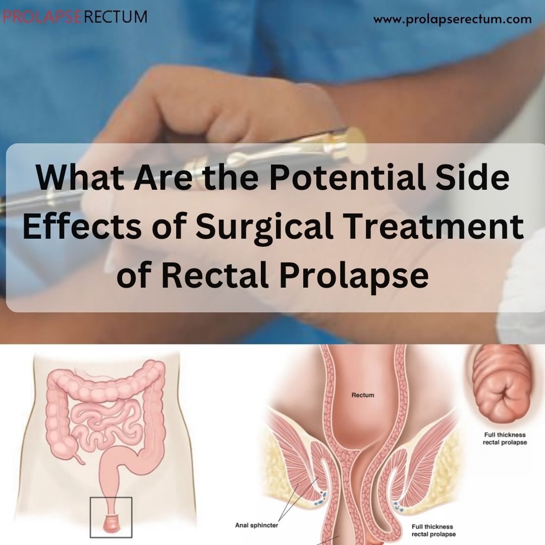 What Are the Potential Side Effects of Surgical Treatment of Rectal Prolapse