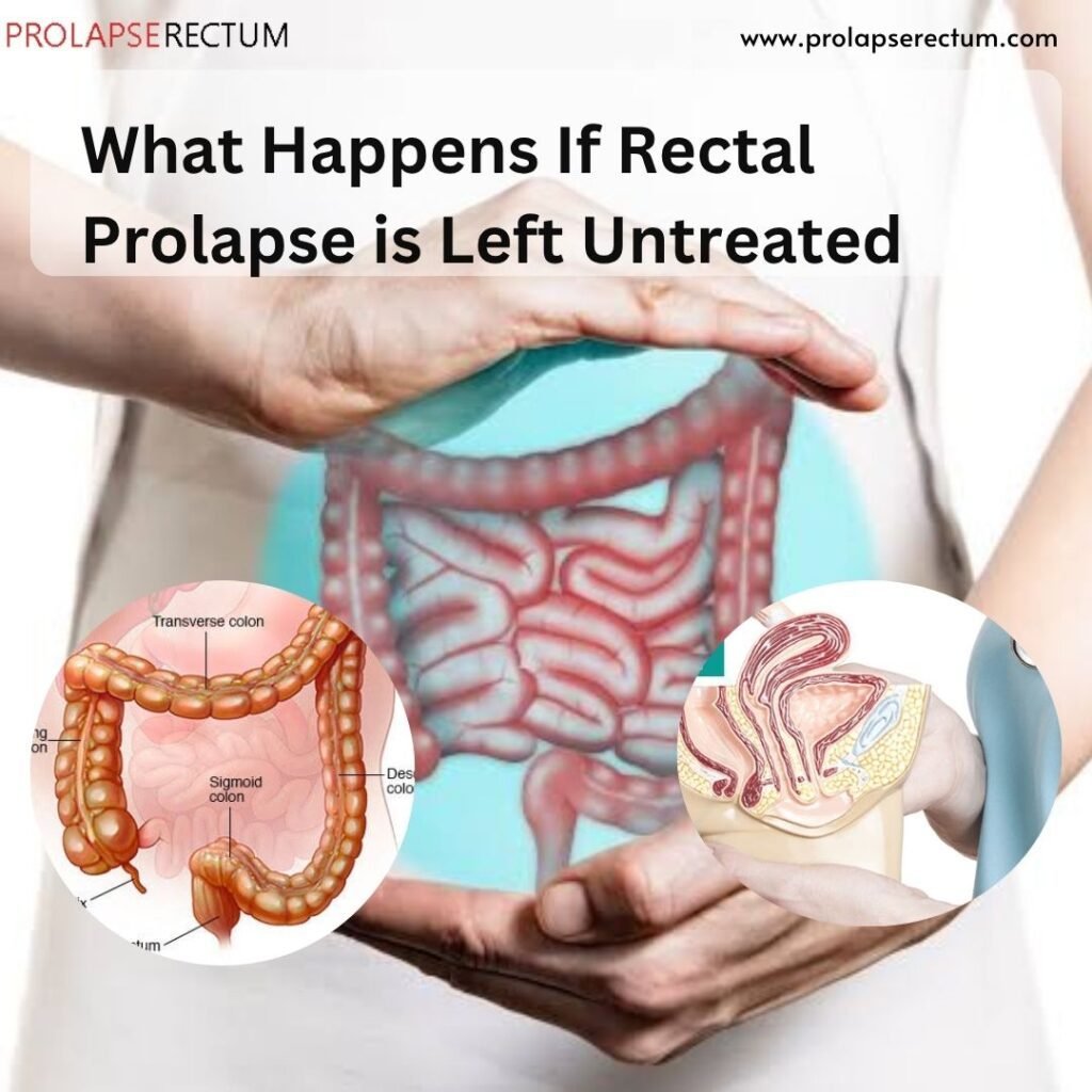 What Happens If Rectal Prolapse is Left Untreated