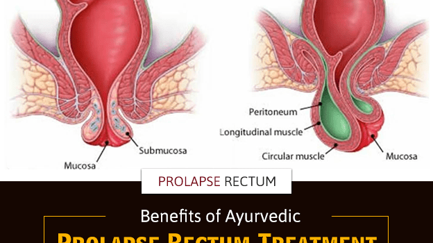 Benefits of Ayurvedic Prolapse Rectum Treatment Benefits of Ayurvedic Prolapse Rectum Treatment (Used 15th Apr)
