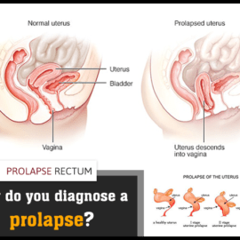 How do you diagnose a prolapse (used 13th May)