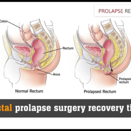 Rectal prolapse surgery recovery time