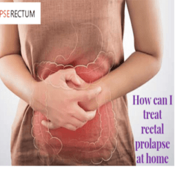How Can I Treat Rectal Prolapse At Home? How Can I Treat Rectal Prolapse At Home?