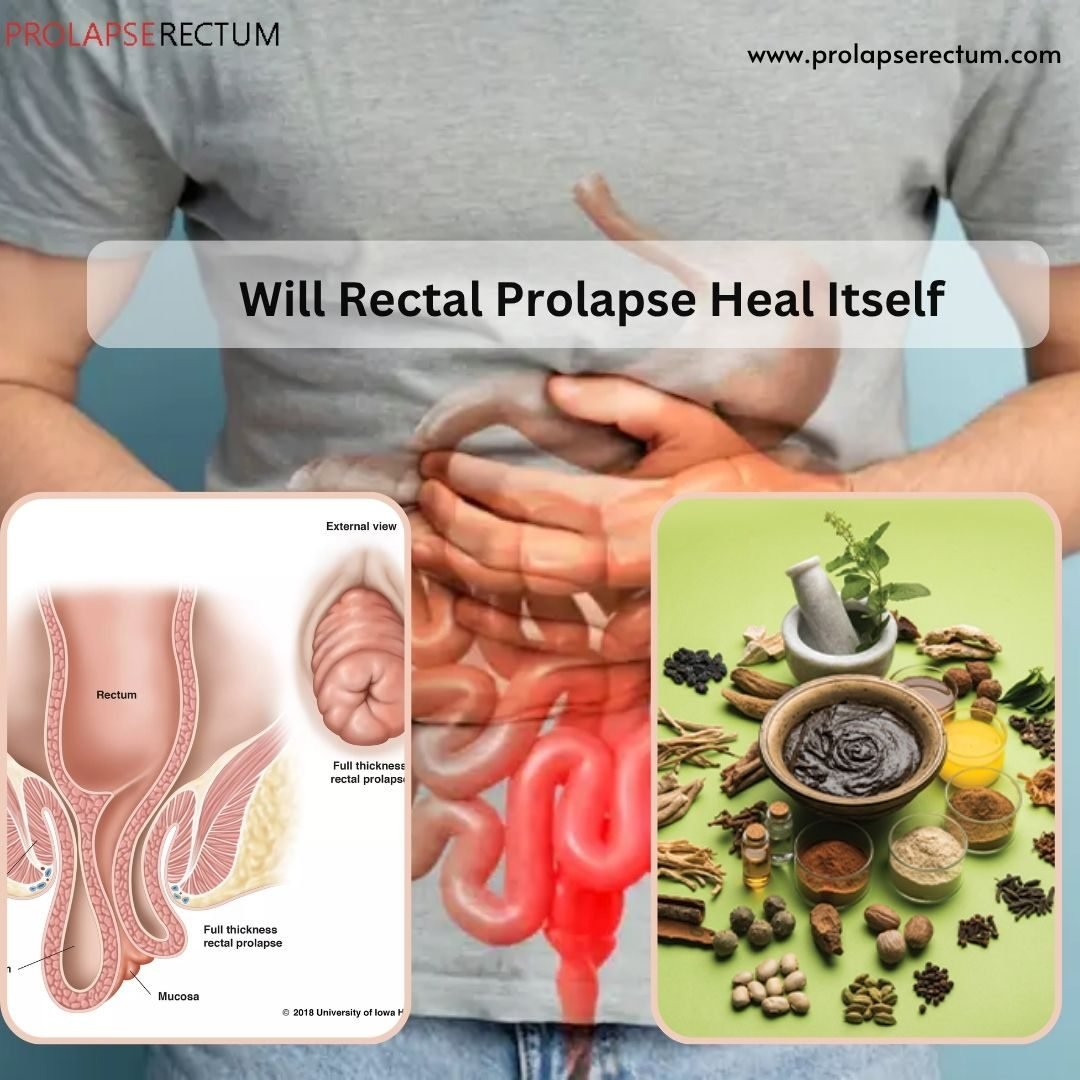Will Rectal Prolapse Heal Itself