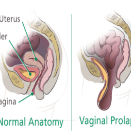 How Do You Fix A Rectal Prolapse?