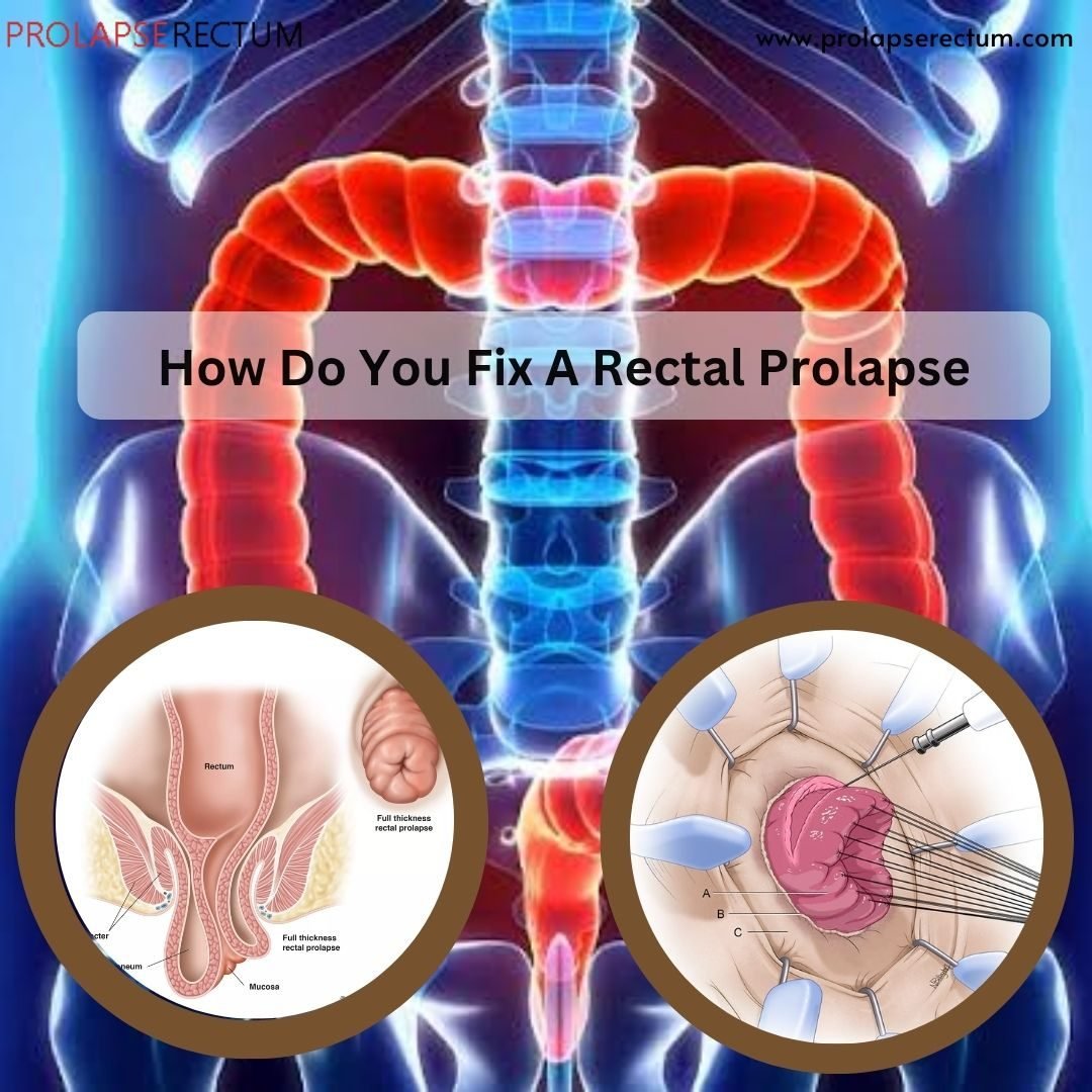 How Do You Fix A Rectal Prolapse
