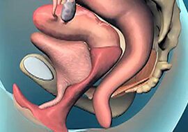 Can You Fix Prolapse without Surgery Can You Fix Prolapse without Surgery