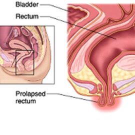 Can You Poop With A Rectal Prolapse