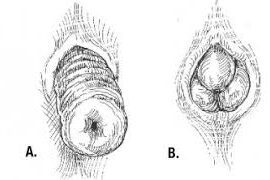 Can Rectal Prolapse Go Away On Its Own? Symptoms Of Rectal Prolapse