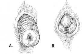 Can Rectal Prolapse Go Away On Its Own? Symptoms Of Rectal Prolapse