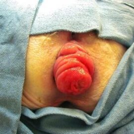 What Does A Prolapsed Bowel Look Like