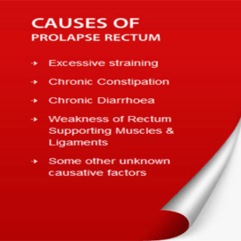 Does Walking Make Prolapse Worse?
