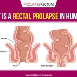 What Is A Rectal Prolapse In Humans? What Is A Rectal Prolapse In Humans?