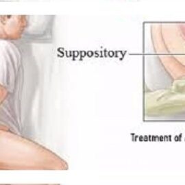 Symptoms of rectal prolapse