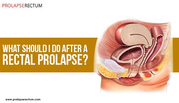 What Should I Do After A Rectal Prolapse? hat should you do after a rectal prolapse