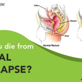 Can You Die From Rectal Prolapse? Can You Die From Rectal Prolapse