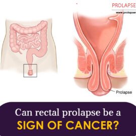Can Rectal Prolapse Be A Sign Of Cancer?