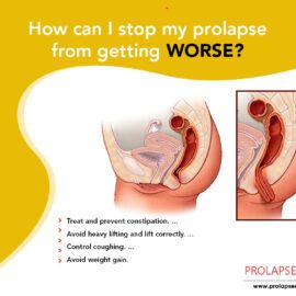 How Can I Stop My Prolapse From Getting Worse?