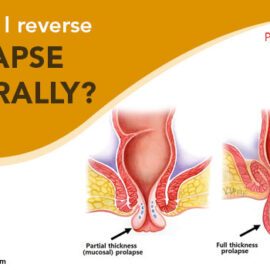How Can I Reverse Prolapse Naturally