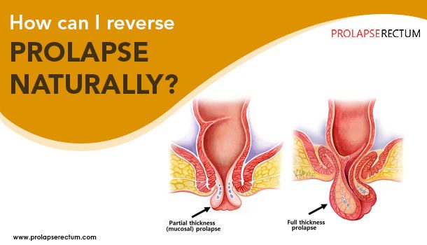 How Can I Reverse Prolapse Naturally How Can I Reverse Prolapse Naturally