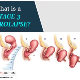 What Is A Stage 3 Prolapse?