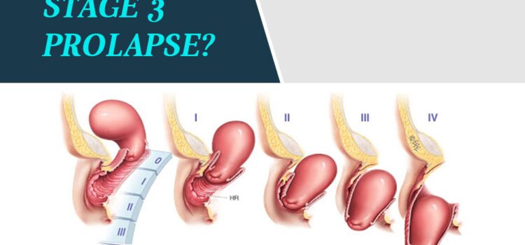What Is A Stage 3 Prolapse? What Is A Stage 3 Prolapse?
