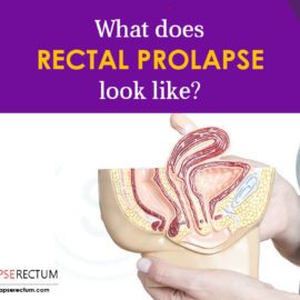 What Does Rectal Prolapse Look Like?