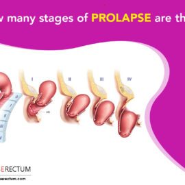 How Many Stages Of Prolapse Are There?