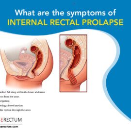 What Are The Symptoms Of Internal Rectal Prolapse? What Are The Symptoms Of Internal Rectal Prolapse?
