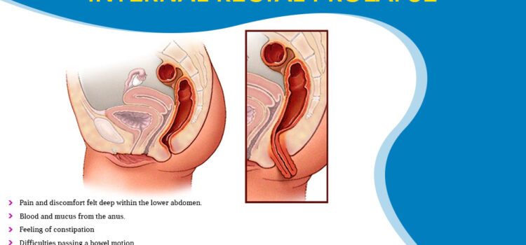 What Are The Symptoms Of Internal Rectal Prolapse?