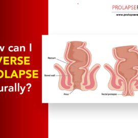 How Can I Reverse Prolapse Naturally?