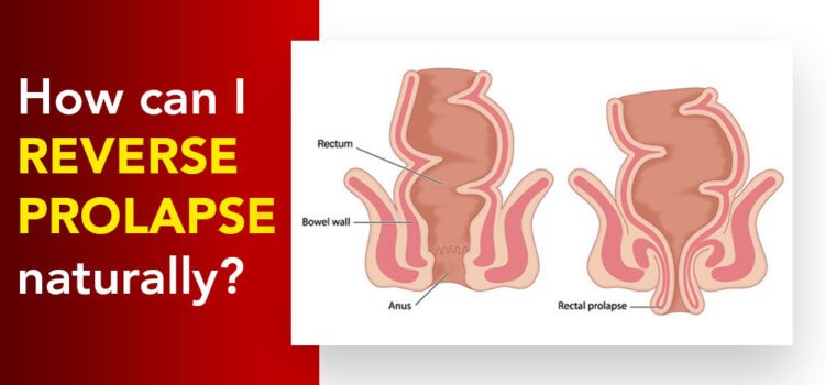 How Can I Reverse Prolapse Naturally? How Can I Reverse Prolapse Naturally?