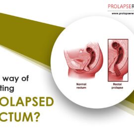 Best Way Of Treating Prolapsed Rectum