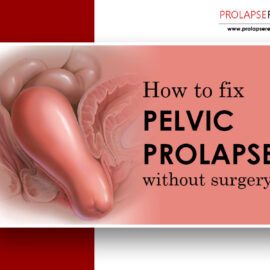 Pelvic Prolapse Without Surgery