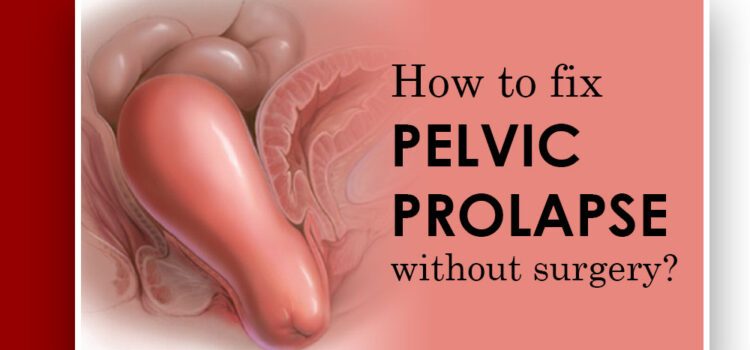 Pelvic Prolapse Without Surgery