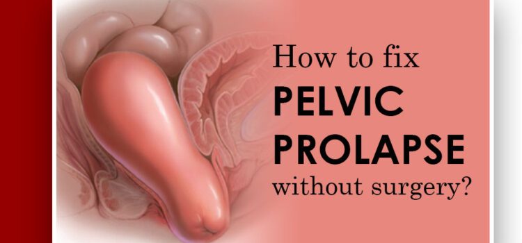 How To Fix Pelvic Prolapse Without Surgery Pelvic Prolapse Without Surgery