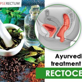 Ayurvedic Treatment For Rectocele