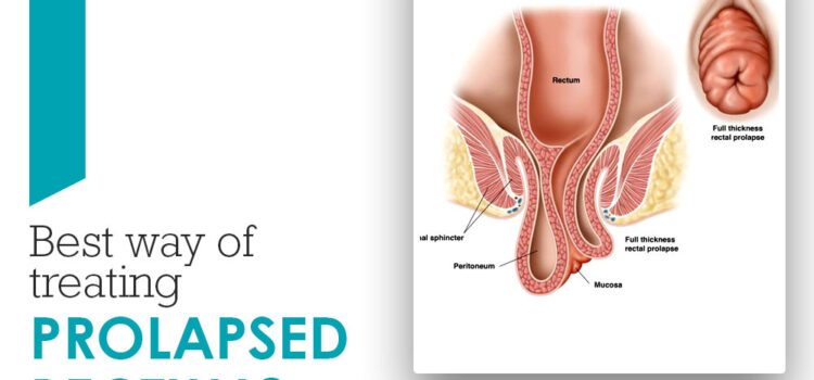 Is It Herbal Treatment Works For Prolapse Rectal?