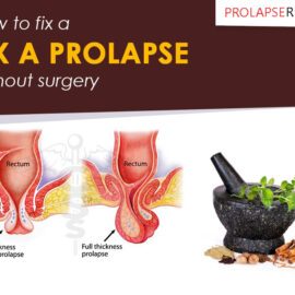 How To Fix A Prolapse Without Surgery