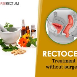 Rectocele Treatment