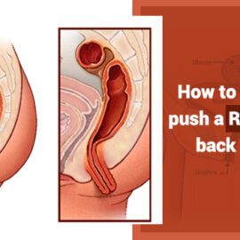 How Do You Push A Rectal Prolapse Back Into Place?
