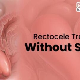 Rectocele Treatment Without Surgery Symptoms Of Rectocele