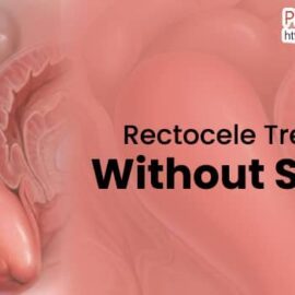 Symptoms Of Rectocele