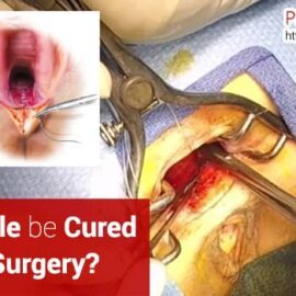 Can Rectocele Be Cured Without Surgery? Can Rectocele Be Cured Without Surgery