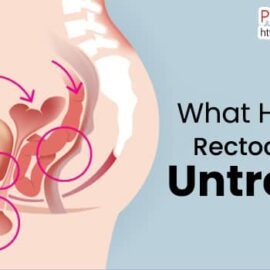 What Happens If Rectocele Goes Untreated
