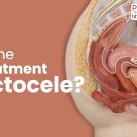Best Non-Surgical Treatments For Rectocele What is the best treatment for Rectocele