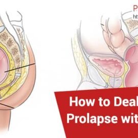 Rectal Prolapse Without Surgery