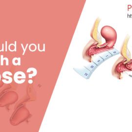 What Should You Not Do With A Prolapse